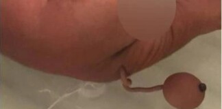 Cậu bé Brazil sinh ra với cái đuôi dài 12 cm giống Doraemon