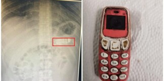 Nuốt nguyên chiếc điện thoại Nokia, nam game thủ đau bụng dữ dội, tới viện khẩn cầu bác sĩ và cái kết