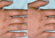 Mụn cóc ở tay chữa thế nào?