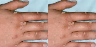 Mụn cóc ở tay chữa thế nào?