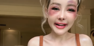 Nữ hoàng thẩm mỹ Ngân 98 gặp sự cố đau đớn, hé lộ về lần phẫu thuật tiếp theo